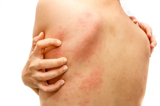 Hautausschlag durch Allergie auf Erkältung