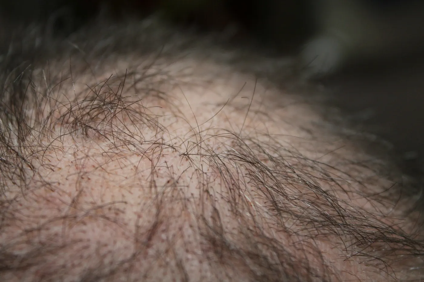 kein Haarausfall mehr - nie wieder Haare verlieren