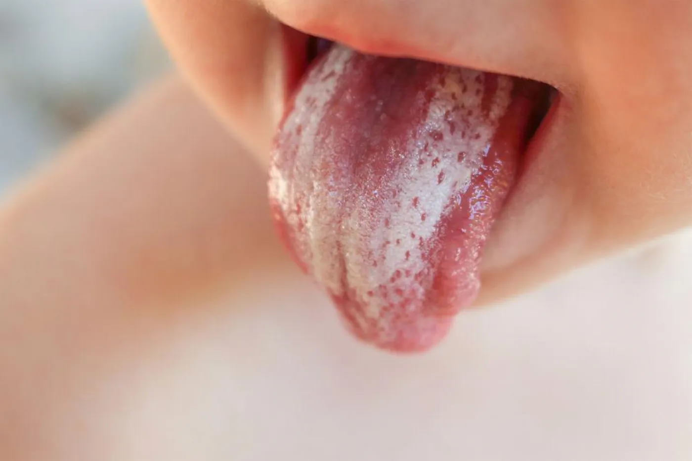Orale Candidose – Mundsoor bei Erwachsenen und Kindern
